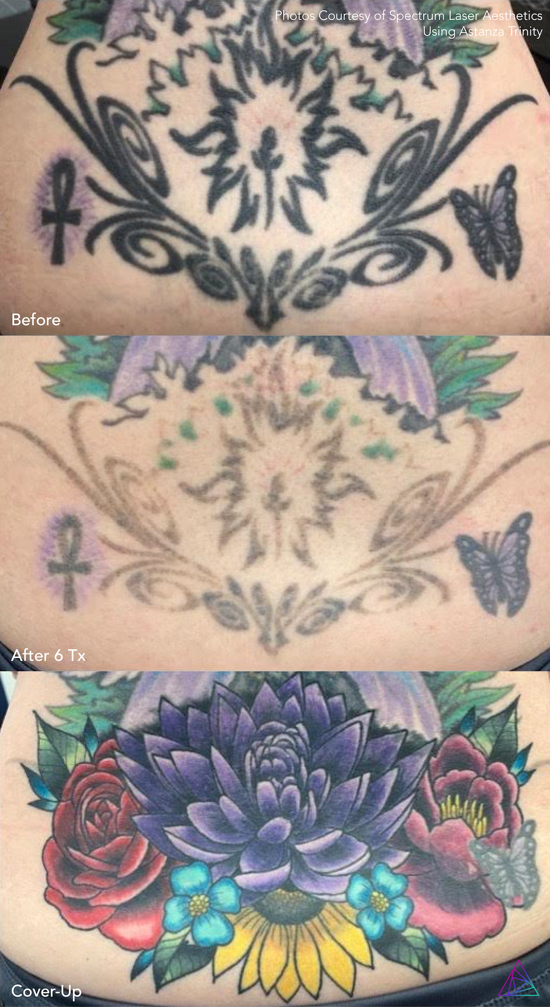 Before and after tattoo removal